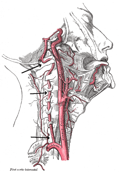 picture of vertebral artery treatment
